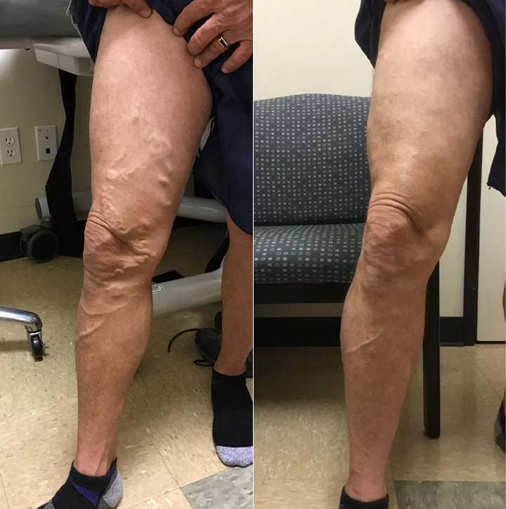 СПРЕЙ ПРОТИ ВАРИКОЗУ