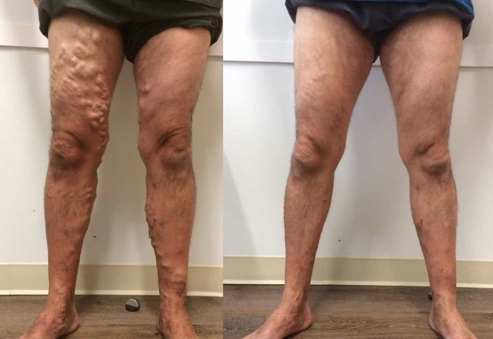 СПРЕЙ ПРОТИ ВАРИКОЗУ